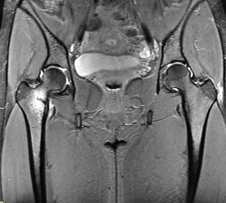 Figure 1 for case Calcar stress fracture ( RID4695 )